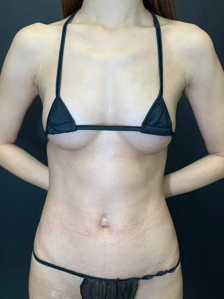 豊胸_ピュアグラフト1＋コンデンス2術後1ヶ月（名医の田中里佳医師が執刀）（35）