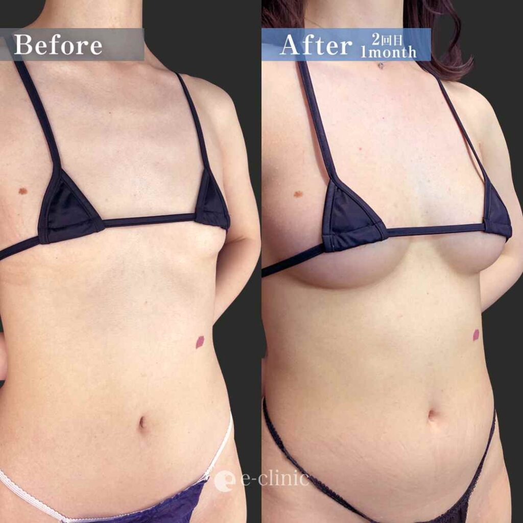 豊胸_コンデンス（田中里佳）（34）