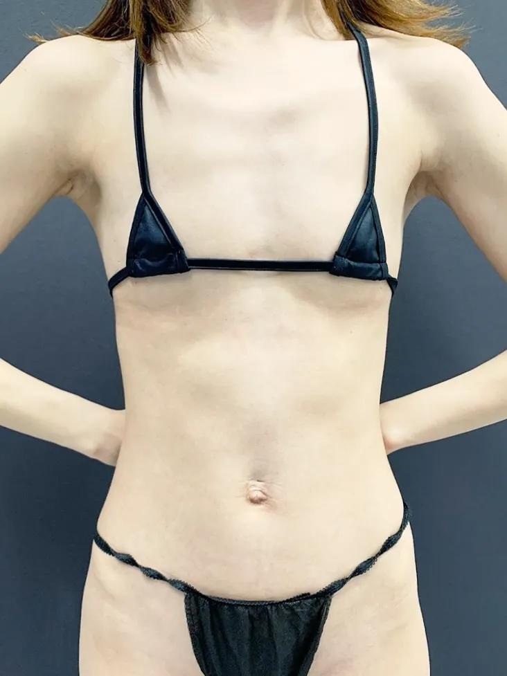 豊胸_ピュアグラフト1＋コンデンス2術前（名医の田中里佳医師が執刀）（35）