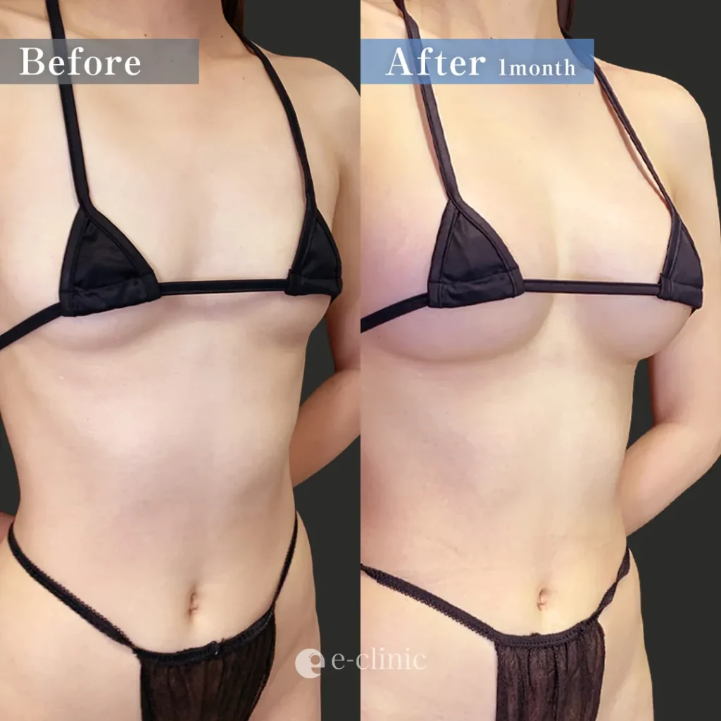 豊胸_ハイブリッド豊胸（田中里佳）（38）