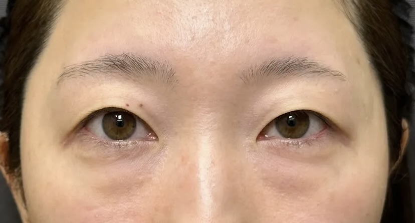 クマ取り_裏ハムラ法+二重整形_自然癒着法術前(劉奕陽)(45)