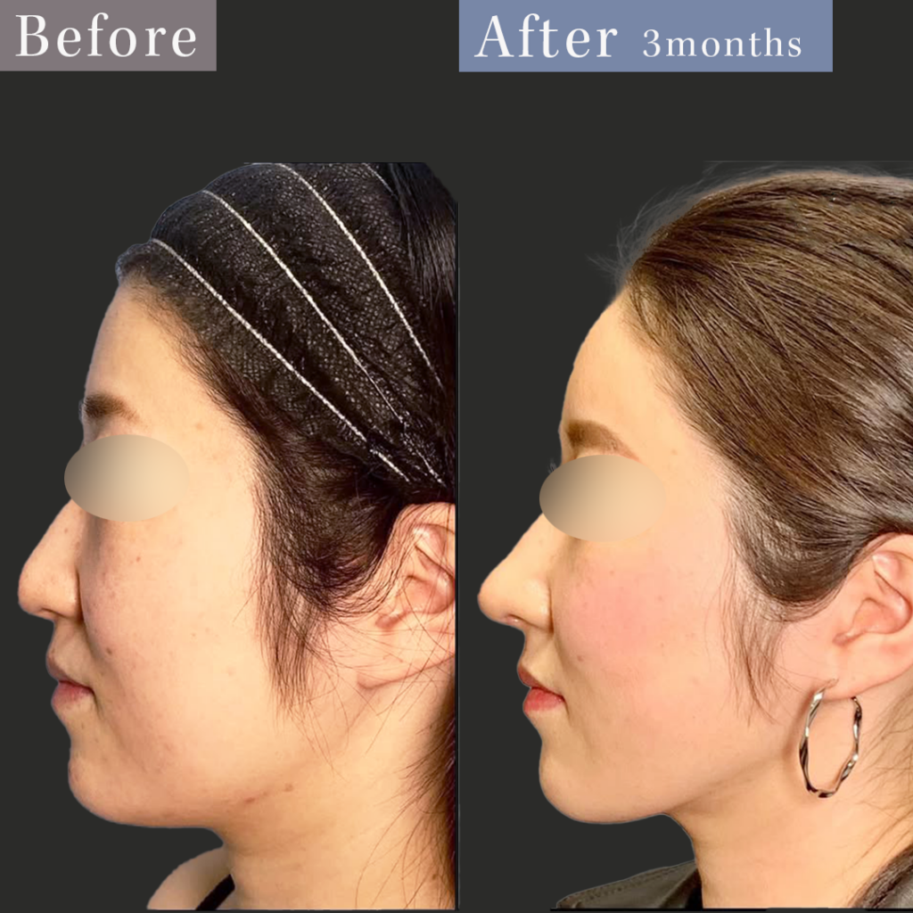 脂肪注入＋脂肪吸引＋糸リフト＋鼻整形_（額・こめかみ・頬上部）＋（顎下・頬下部）＋糸16本＋鼻中隔延長＋鼻尖形成（円戸望）（108）