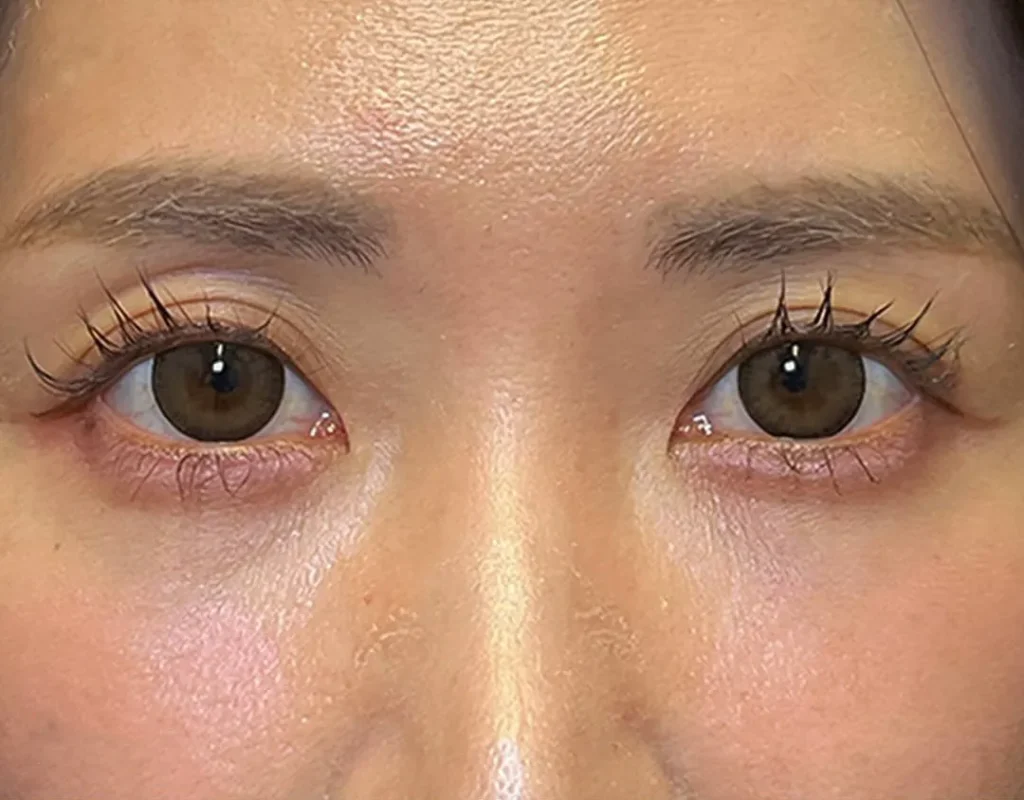 クマ取り_経結膜脱脂＋脂肪注入術前（名医の劉奕陽医師が執刀）（47）