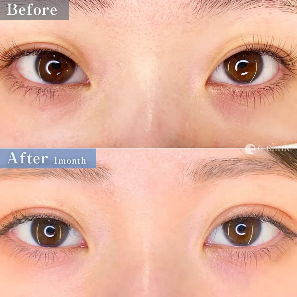 二重埋没_フォーエバークロス特殊5点留め（劉奕陽）（52）