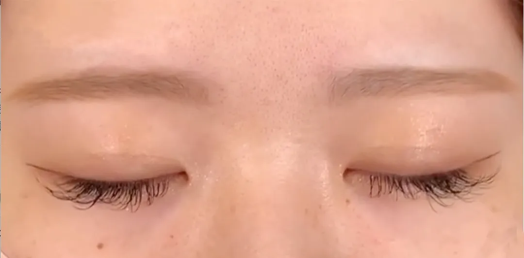 二重整形_埋没法 自然癒着法術閉眼(劉奕陽)(46)