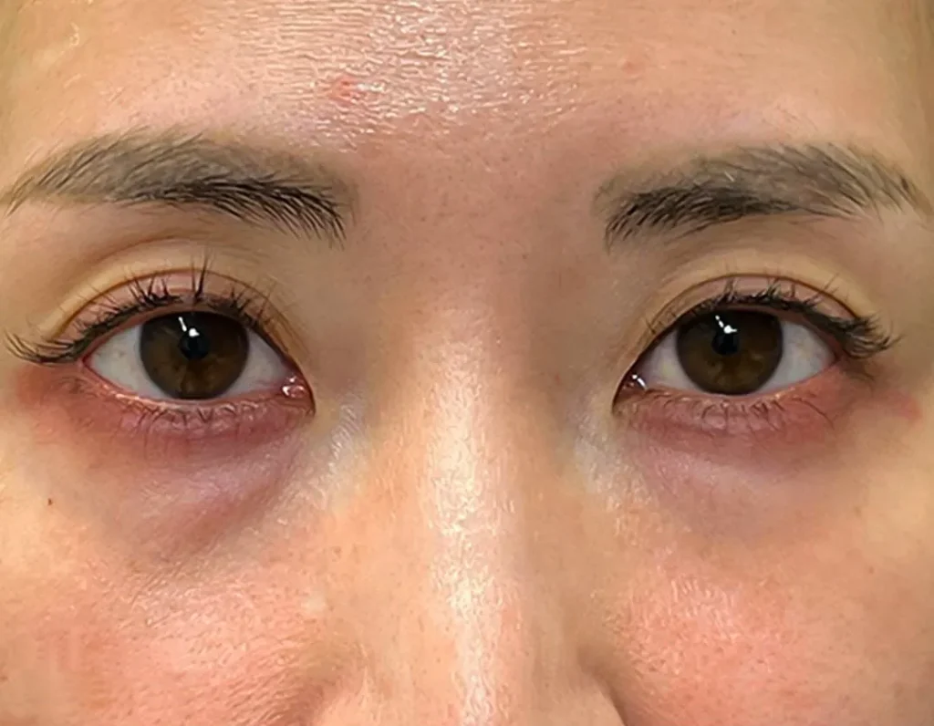 クマ取り_経結膜脱脂＋脂肪注入術前（劉奕陽）（47）