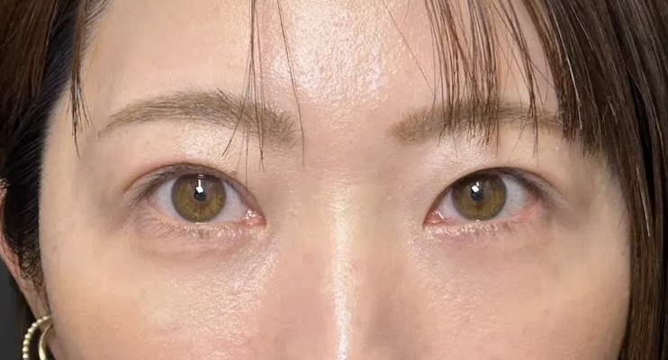 クマ取り_裏ハムラ法+二重整形_自然癒着法術後1ヶ月(名医の劉奕陽医師が執刀)(45)