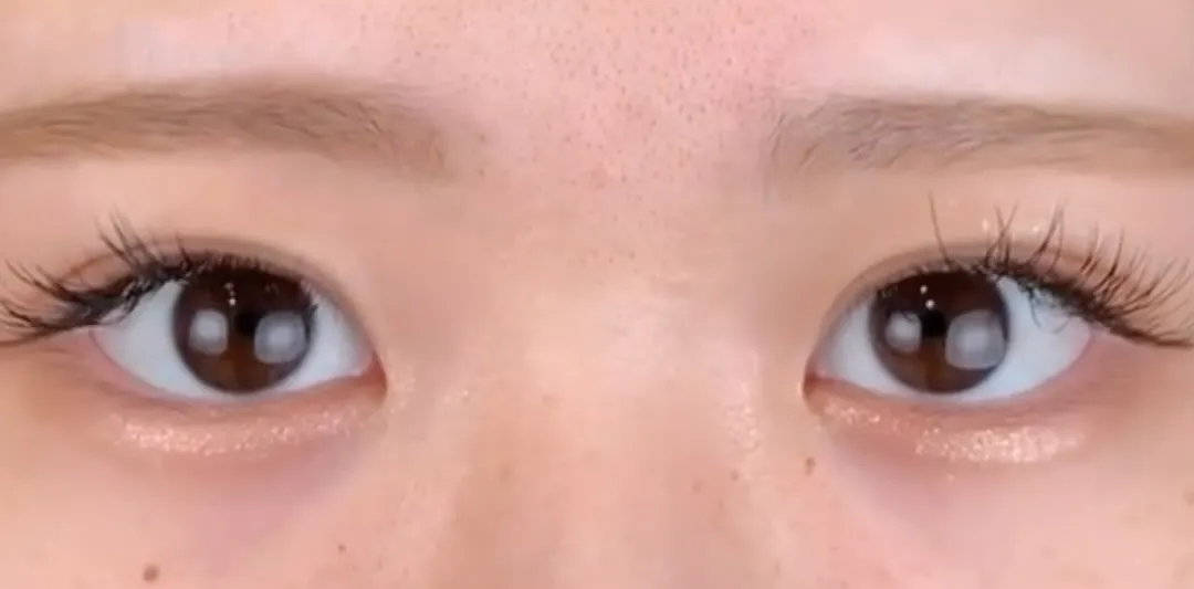 二重整形_埋没法 自然癒着法術後1ヶ月(劉奕陽)(46)