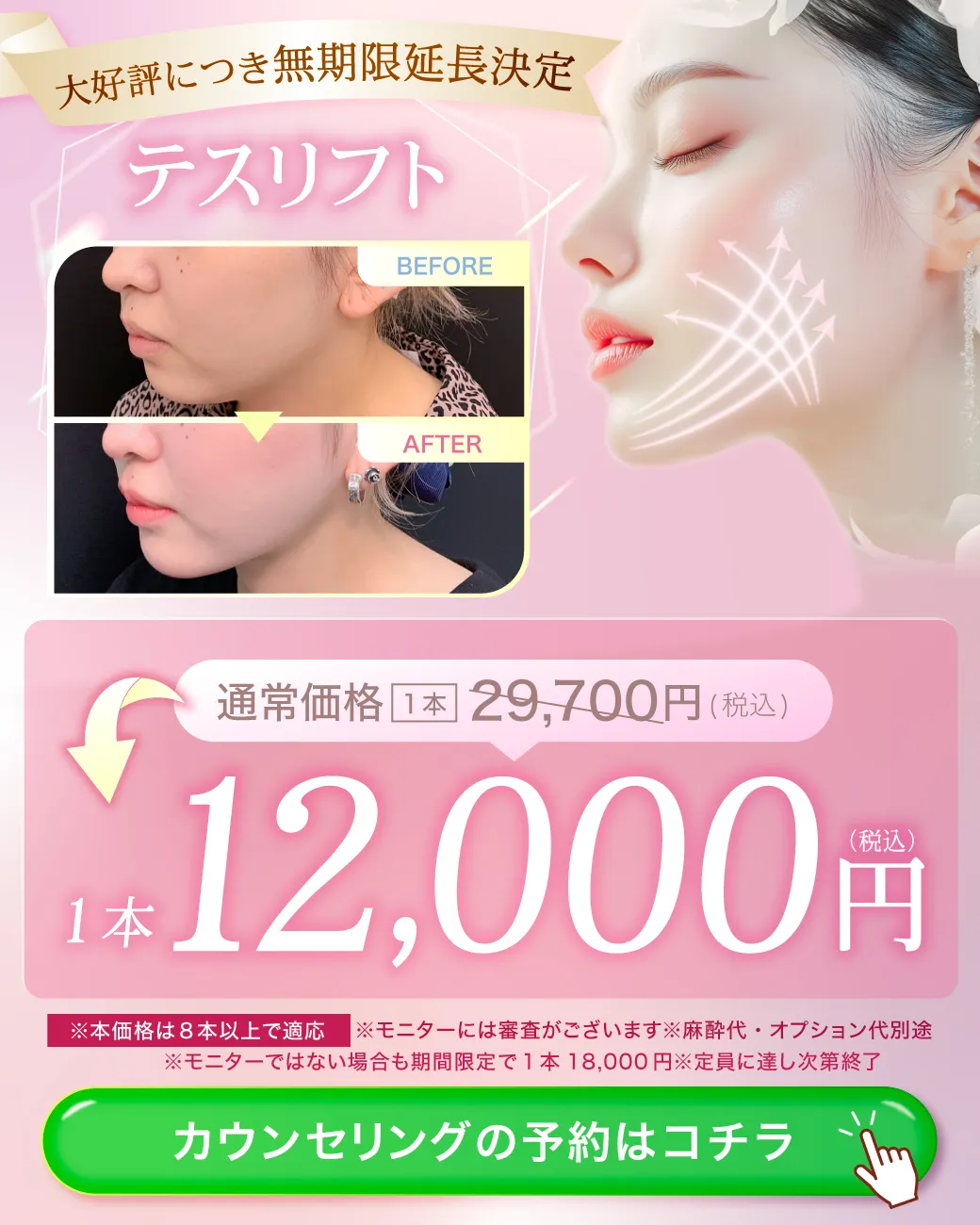 閑散期糸リフト