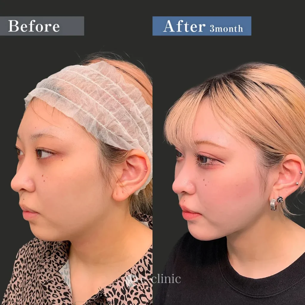 Ultra-Z脂肪吸引（頬・顎下・ジョールファット・メーラーファット）＋糸リフト（スレッドリフトプレミアム8本＋テスリフト8本）＋顎ヒアルロン酸（円戸望）（25）