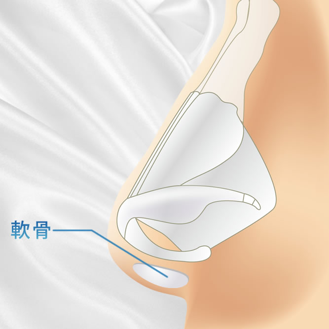 鼻柱下降の軟骨を移植した図解