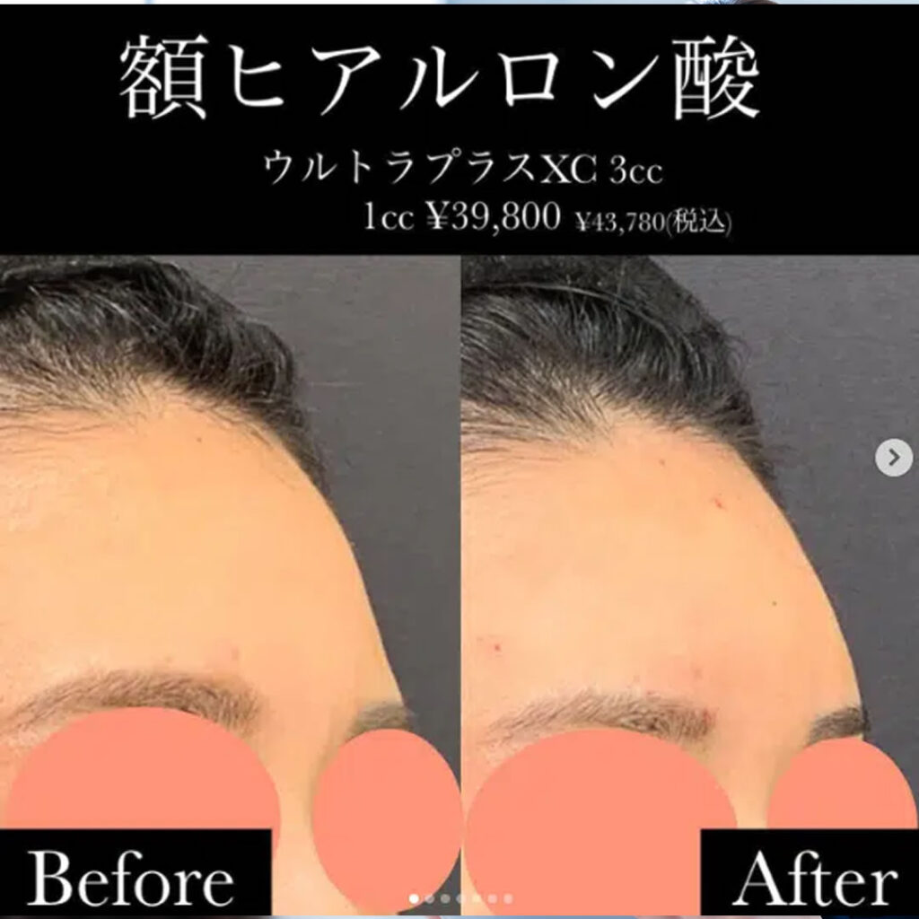 額のヒアルロン酸の症例写真