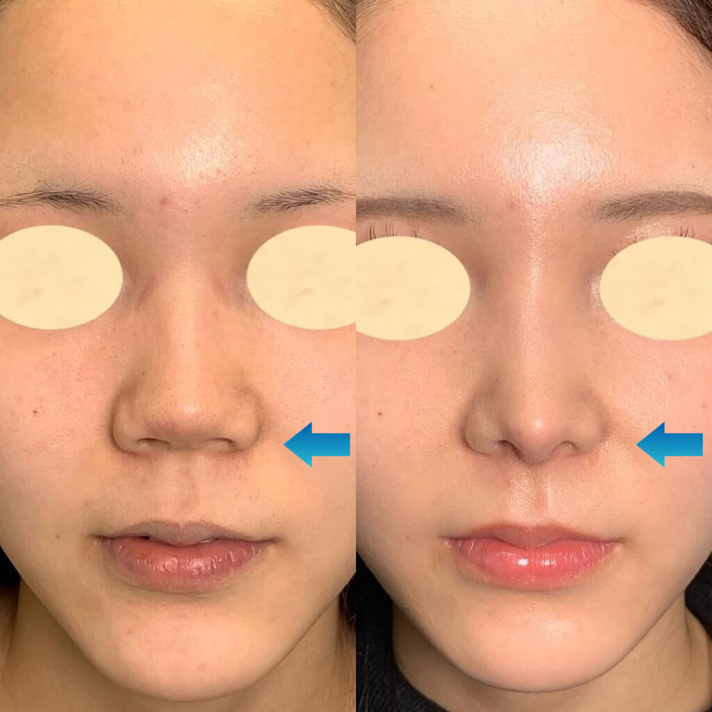 鼻柱下降の症例写真