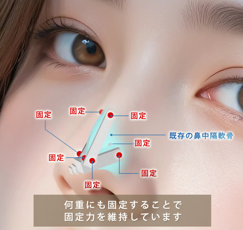肋軟骨を鼻中隔軟骨に複数個所で固定
