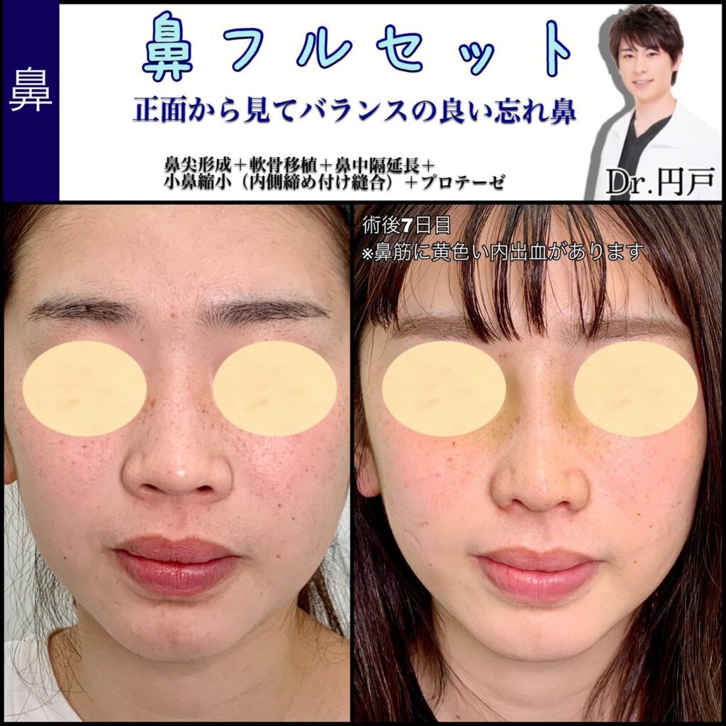 鼻尖形成、軟骨移植、鼻中隔延長、小鼻縮小、プロテーゼを同時に行った1週間後の症例写真