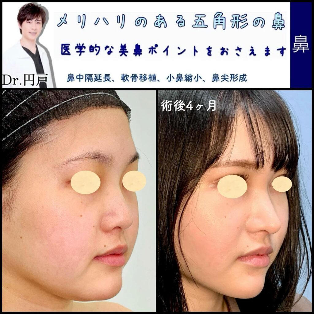 肋軟骨の鼻中隔延長と鼻尖形成と小鼻縮小と軟骨移植の症例