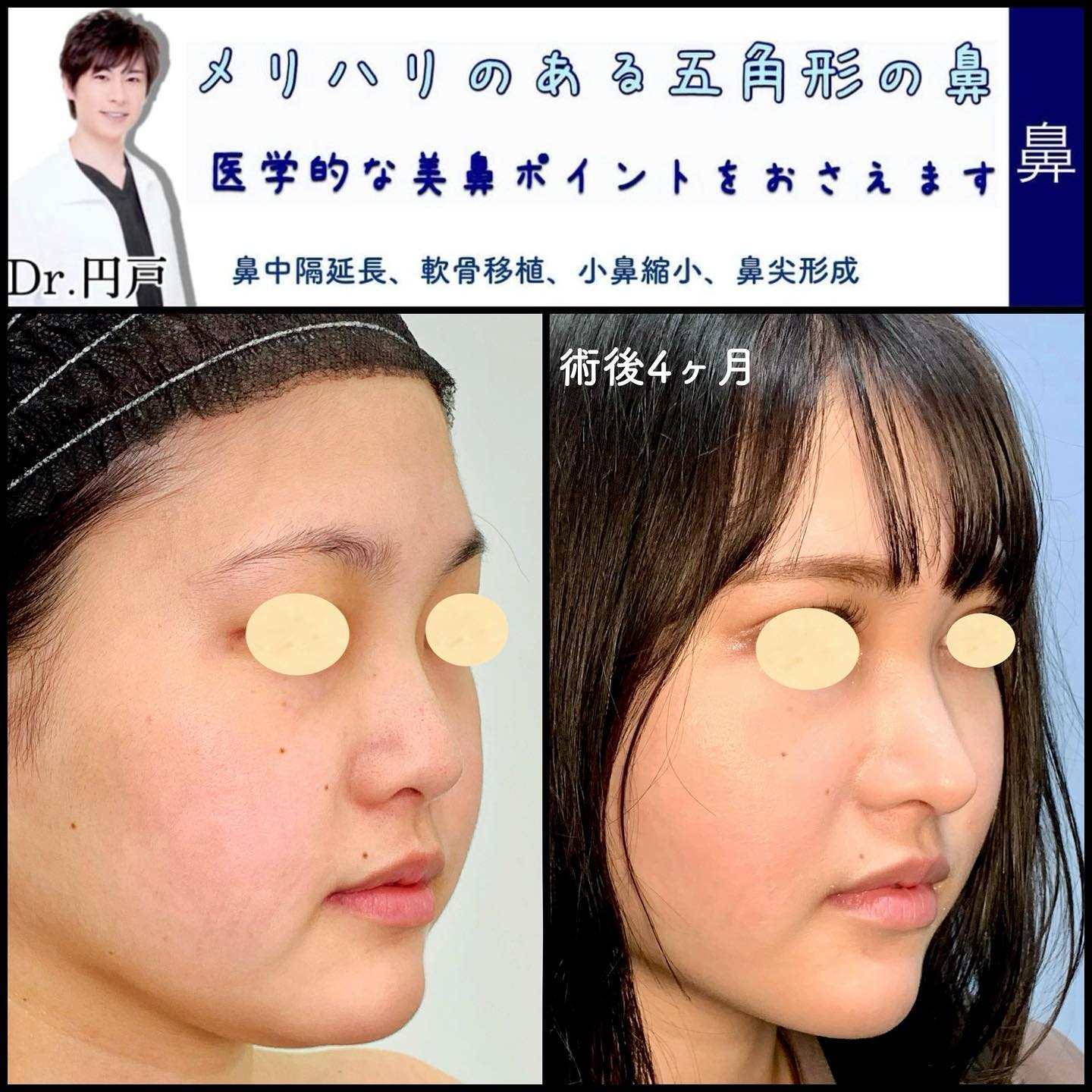 肋軟骨の鼻中隔延長と鼻尖形成と小鼻縮小と軟骨移植の症例