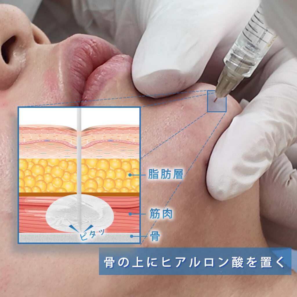 ヒアルロン酸を顎の骨膜上に注入している図解