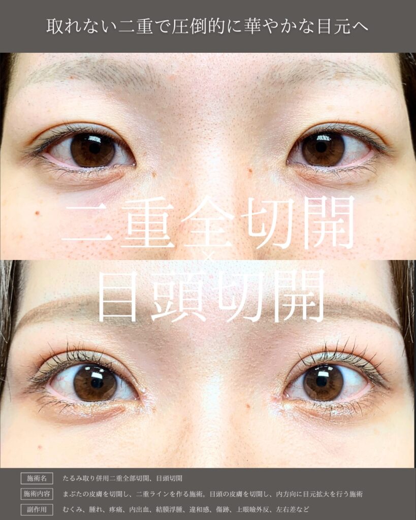 埋没法と目頭切開症例写真 (3)