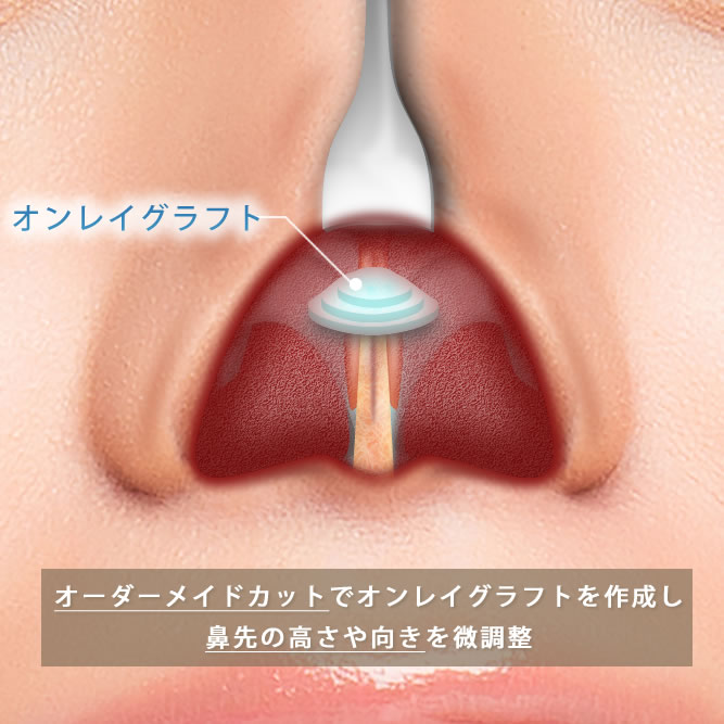鼻尖形成の図解