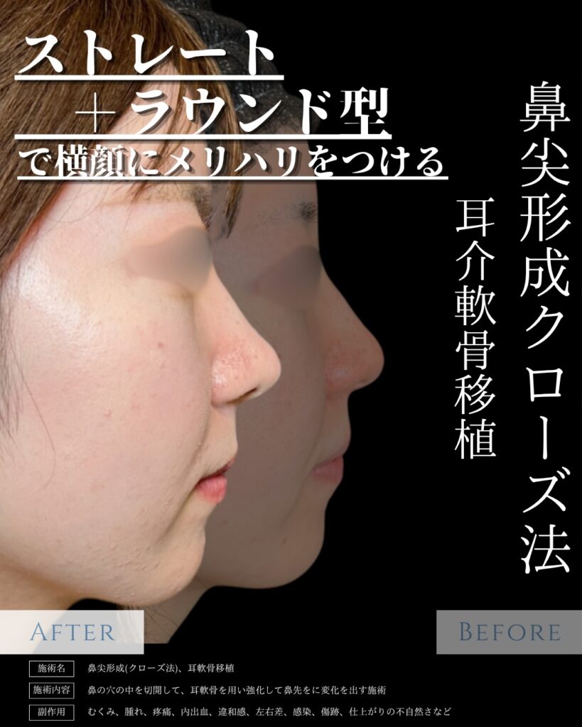 鼻尖形成と耳介軟骨移植の症例写真 (11)