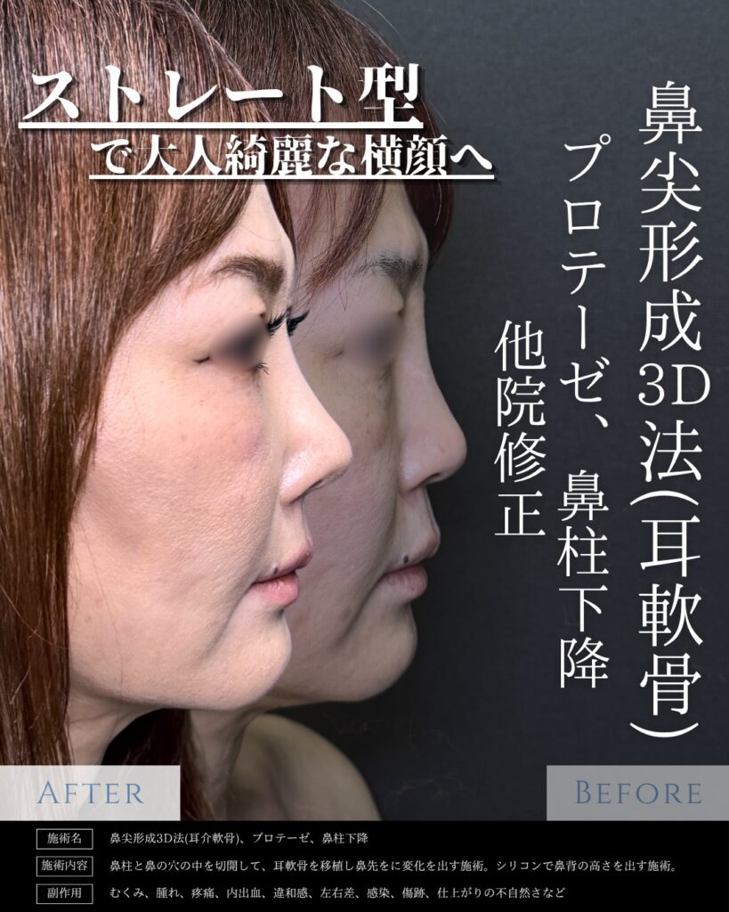 40代の鼻尖形成3D法と耳介軟骨移植と鼻柱下降とプロテーゼの症例