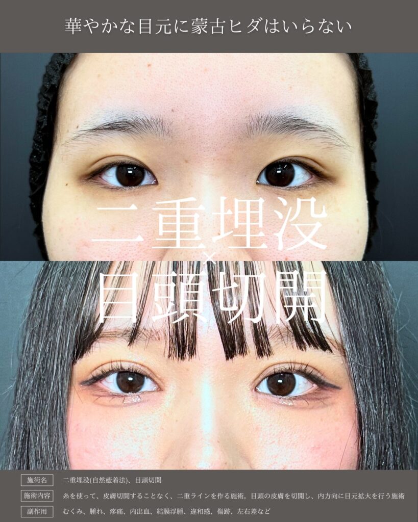 埋没法と目頭切開の症例写真
