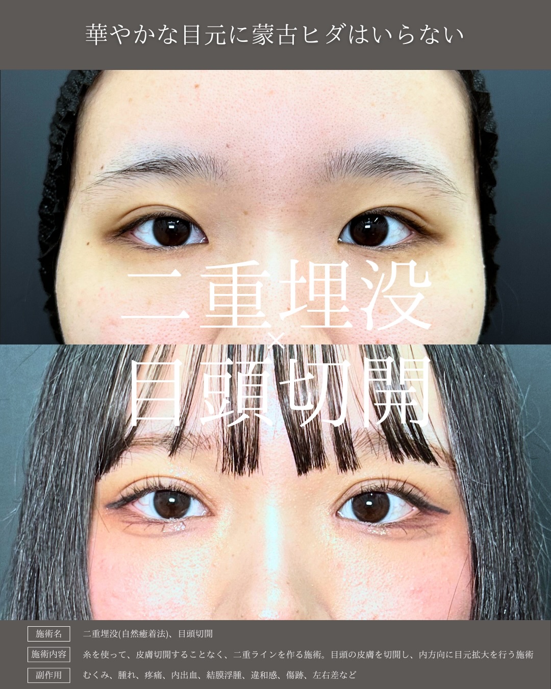 埋没法と目頭切開の症例写真