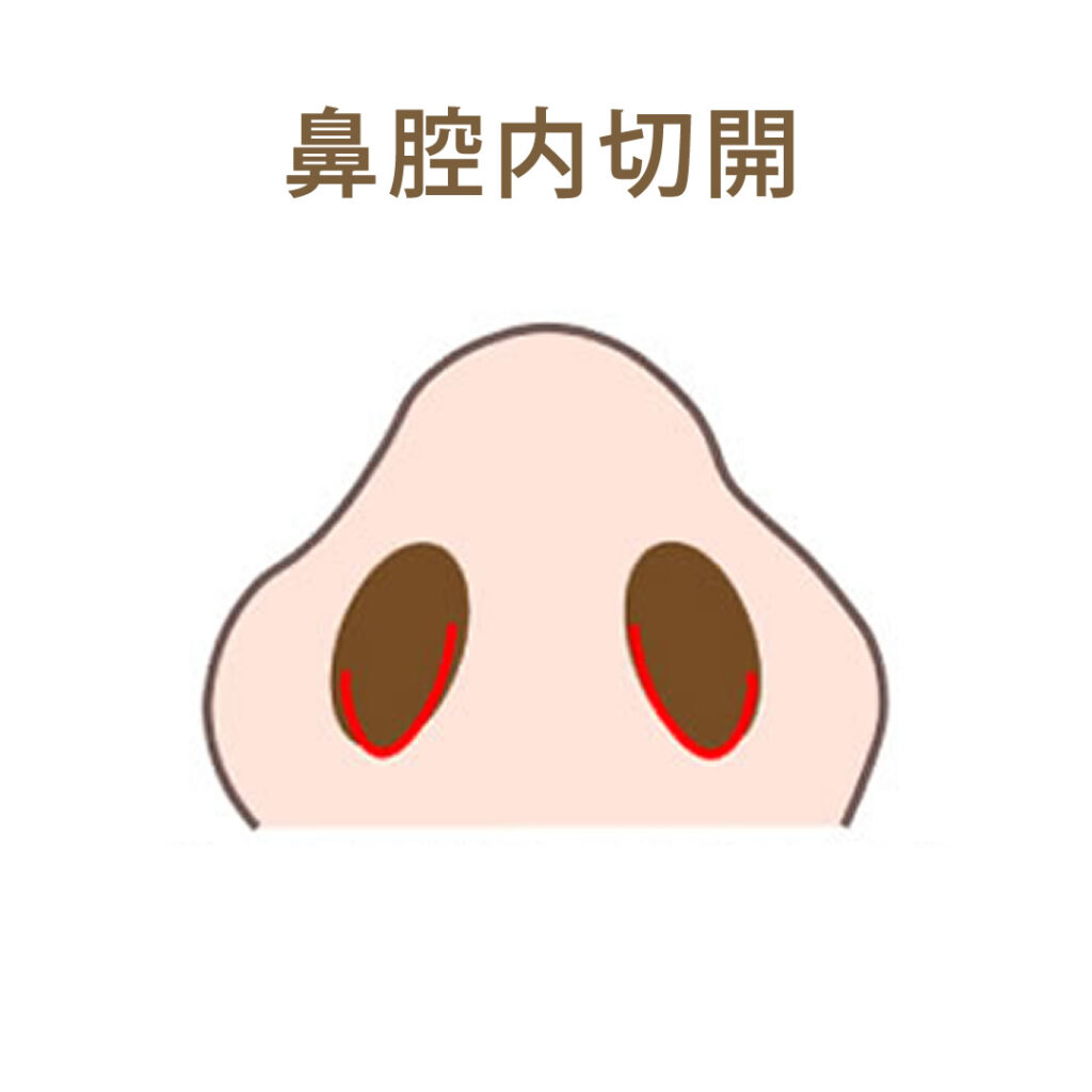 鼻腔内切開のイメージ