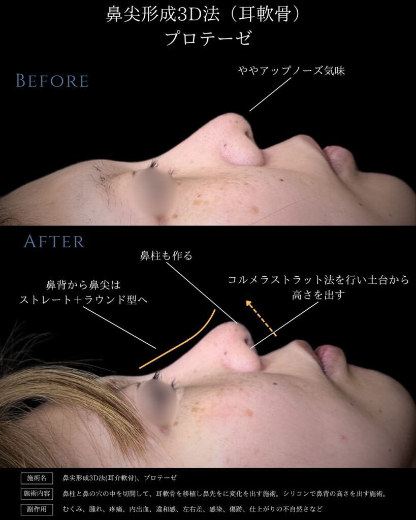 鼻尖形成クローズ法、耳介軟骨移植、鼻背プロテーゼの３か月後の症例