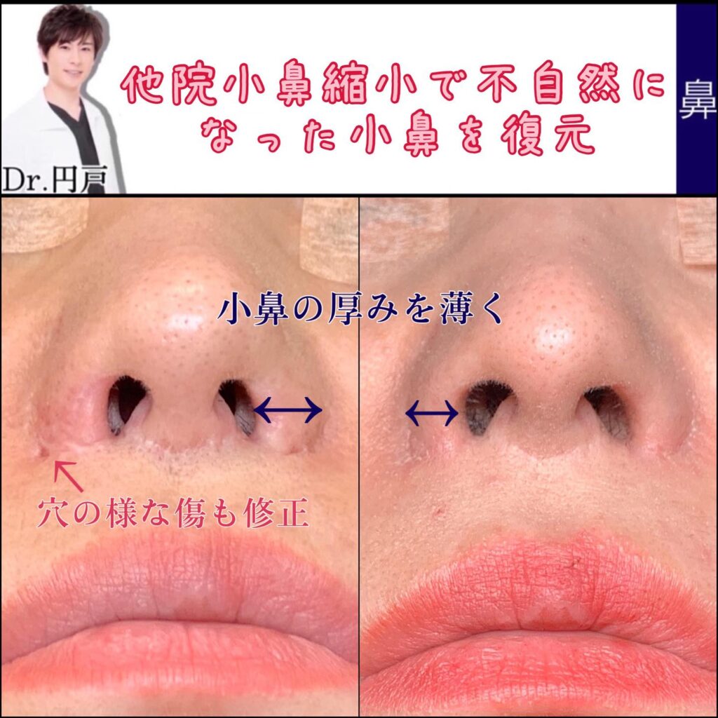 鼻翼拡大修正術(小鼻縮小の他院修正)の症例