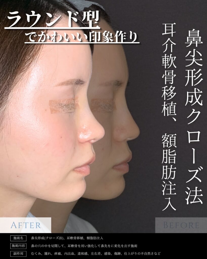 鼻尖形成と耳介軟骨移植と額の脂肪注入症例写真 (9)