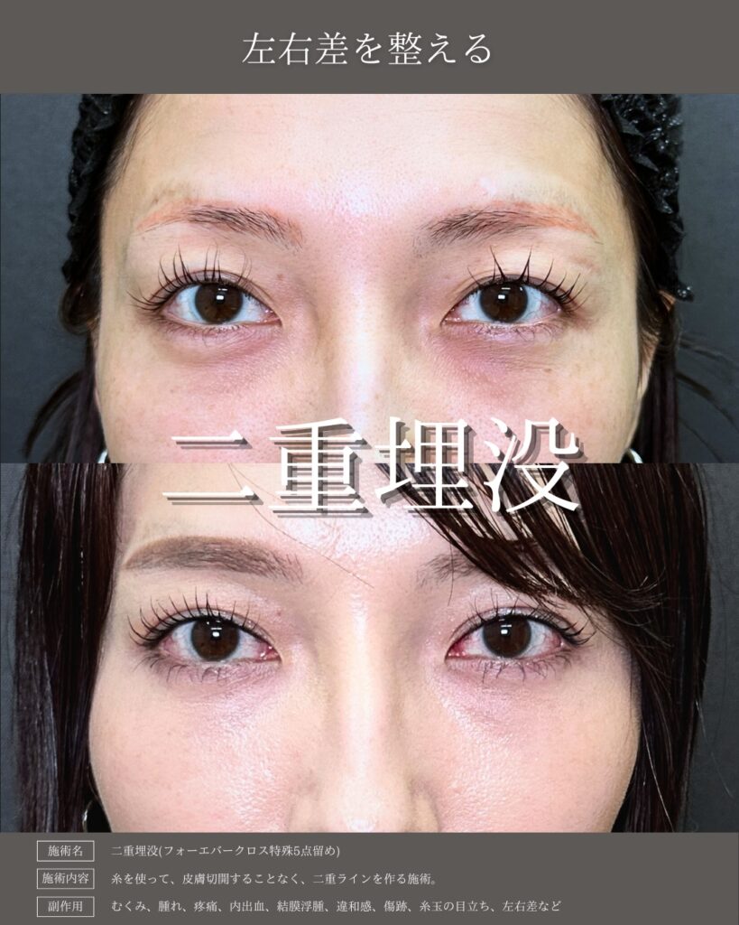 埋没法の症例写真 (21)