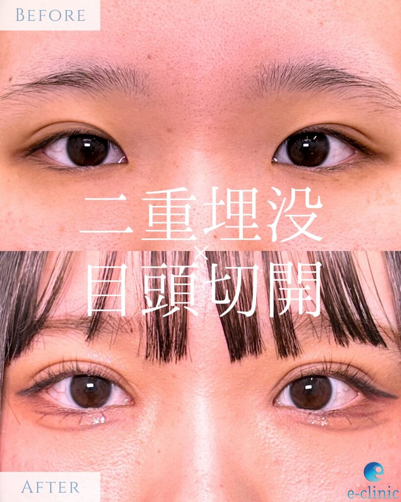 埋没法と目頭切開症例写真 (1)