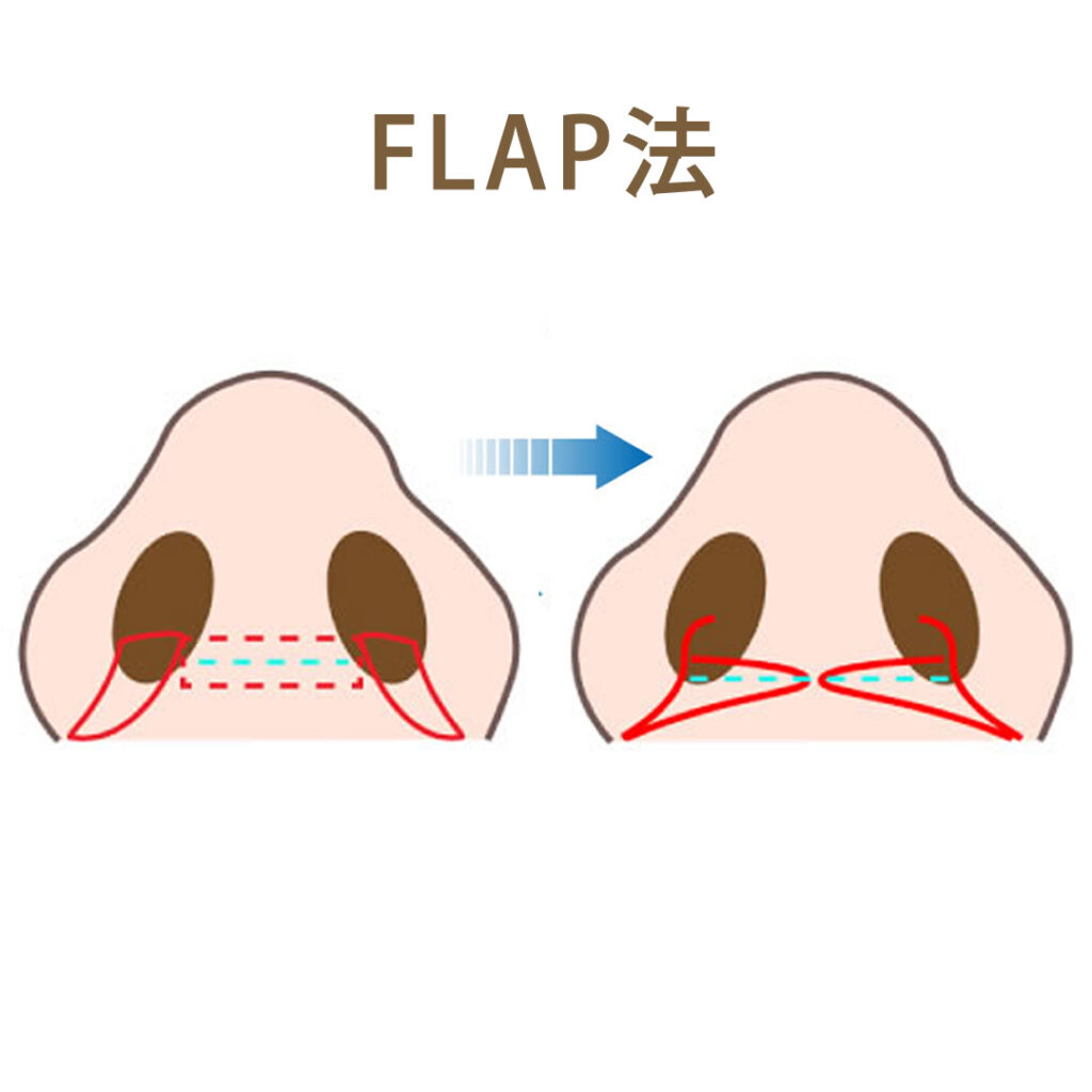 小鼻縮小FLAP法の図解