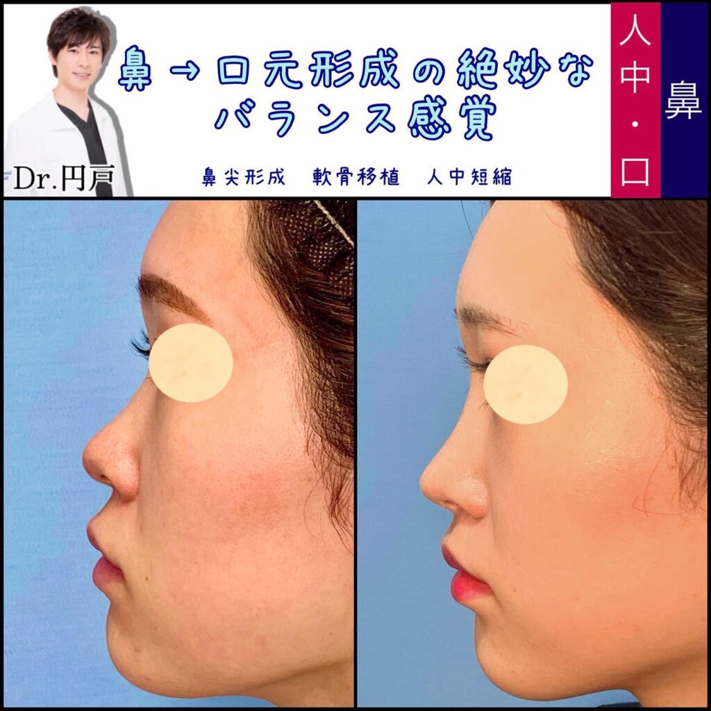 鼻唇角形成の症例写真
