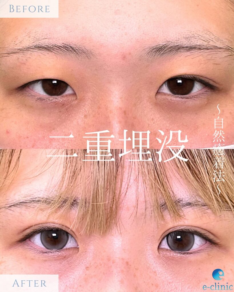 自然癒着法の症例写真 (11)