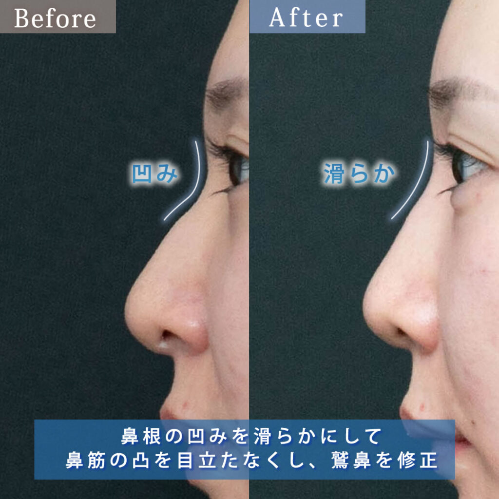 鼻根のヒアルロン酸の症例写真