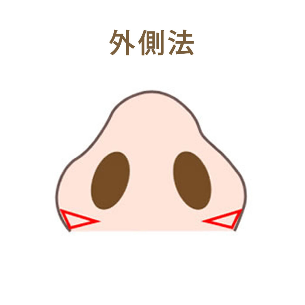 小鼻縮小外側法の図解
