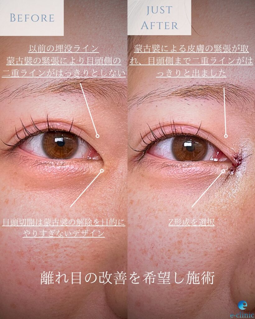 目頭切開の説明の症例写真 (2)