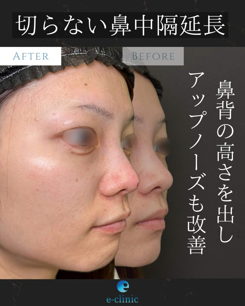 糸を使用した切らない鼻中隔延長の症例