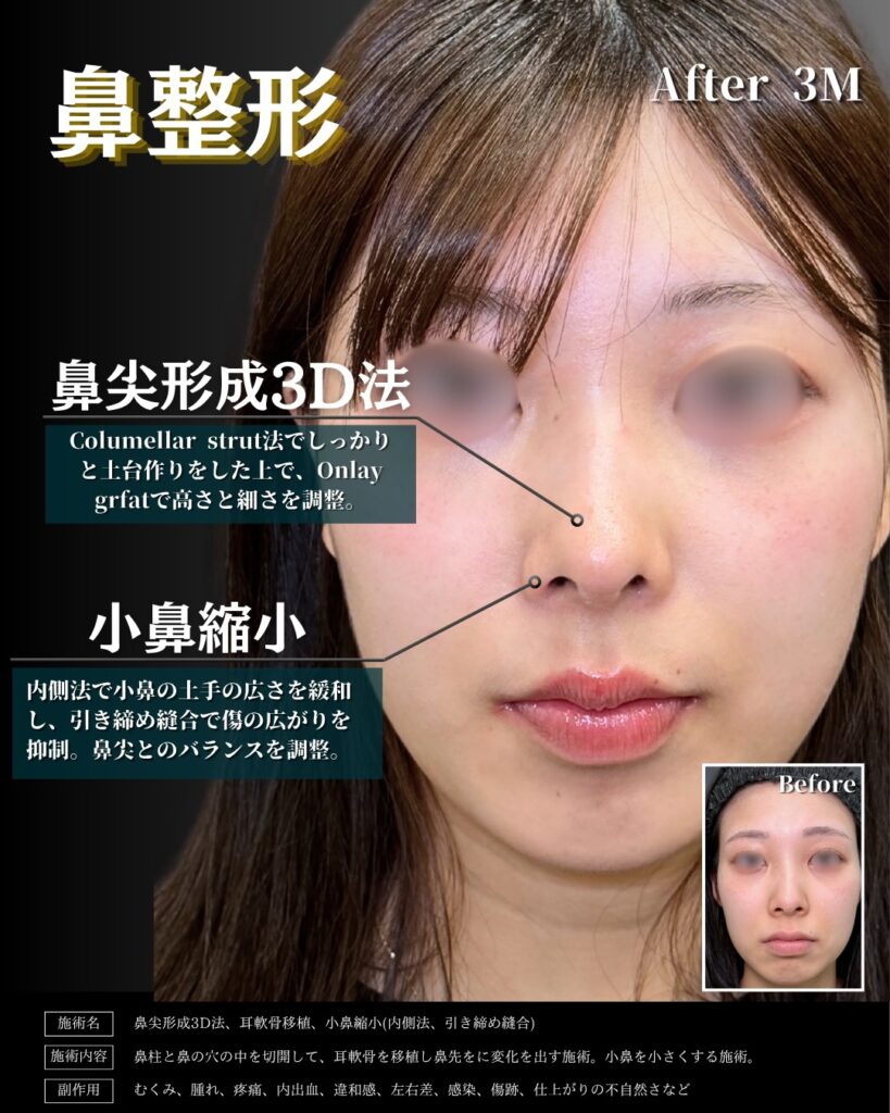 鼻尖形成と耳介軟骨移植と小鼻縮小の症例写真 (1)