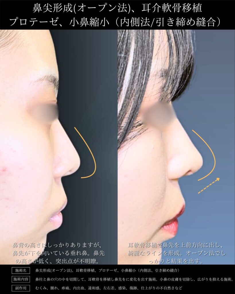 オープン法で行った鼻尖形成3D法、耳介軟骨移植、プロテーゼ、小鼻縮小（内側法引き締め縫合）の３か月後の症例写真