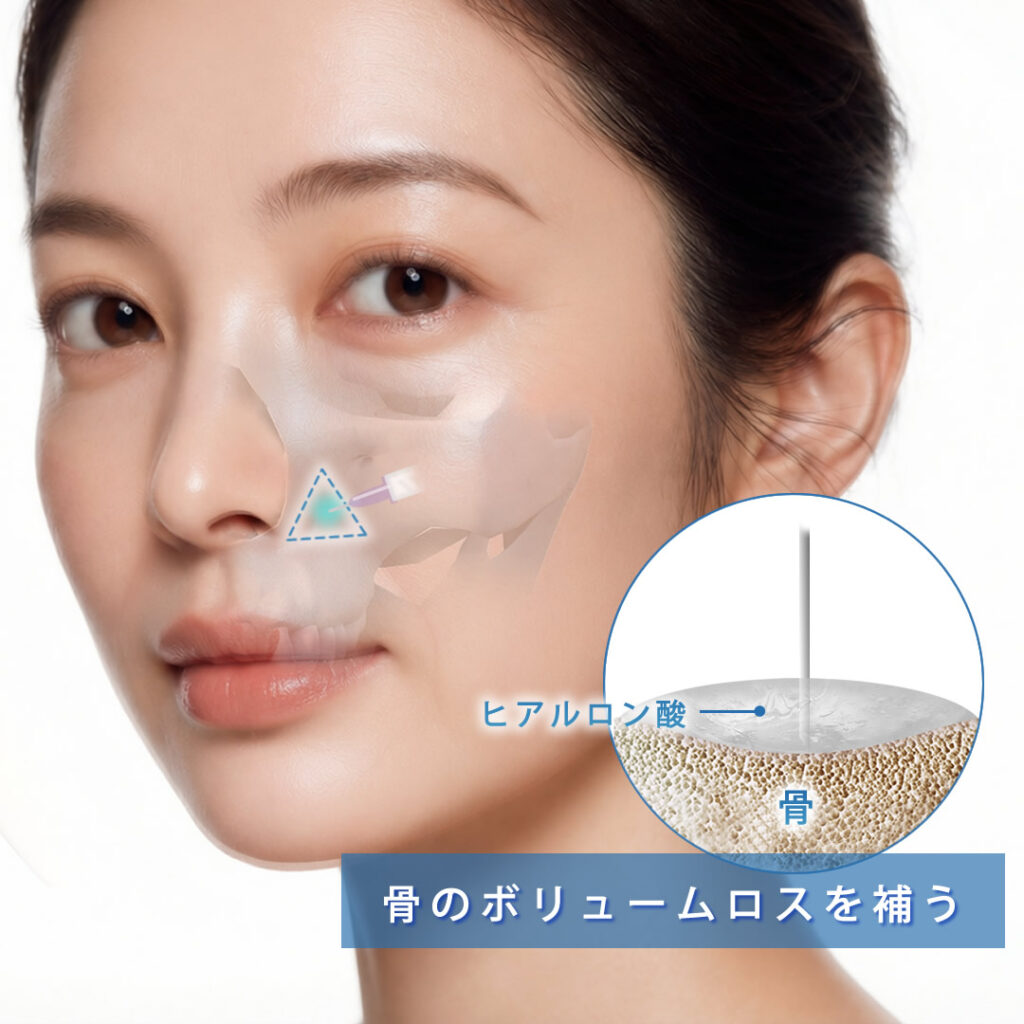 鼻翼基部の骨のボリュームロスを補うヒアルロン酸の注入の図解