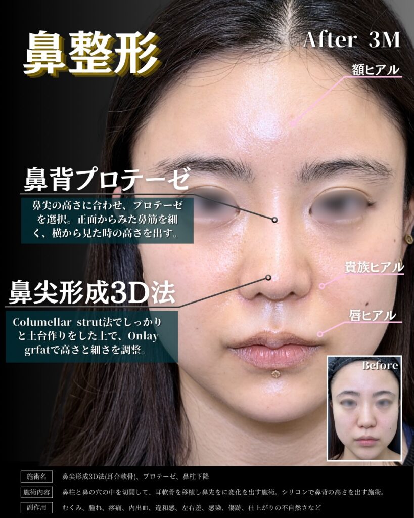 鼻尖形成とプロテーゼと貴族ヒアルと唇のヒアルロン酸の症例写真 (1)