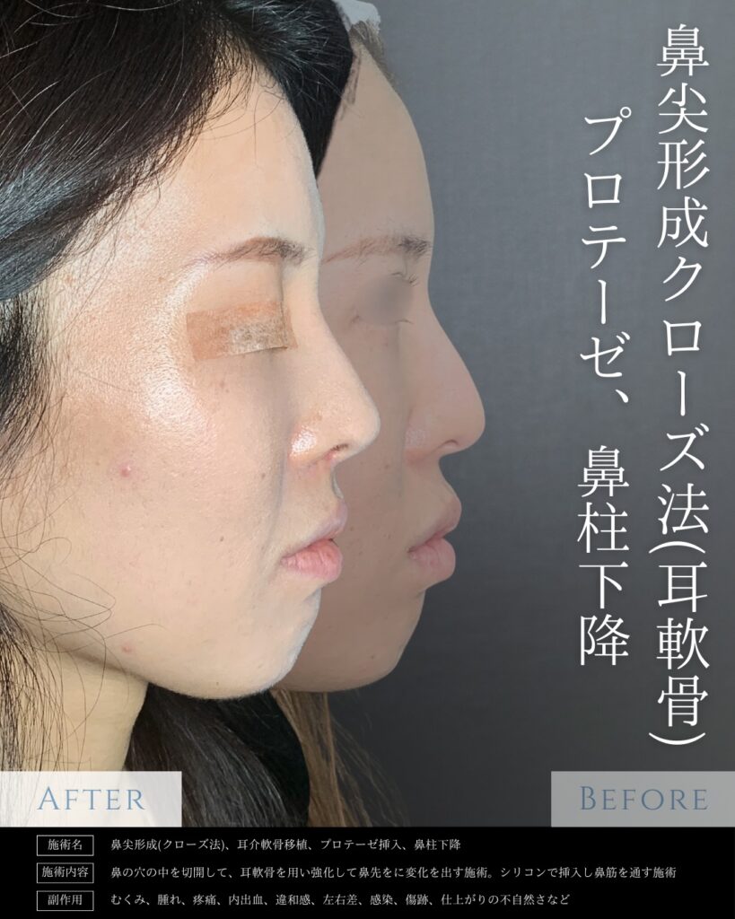 鼻尖形成とプロテーゼと鼻柱下降の症例写真