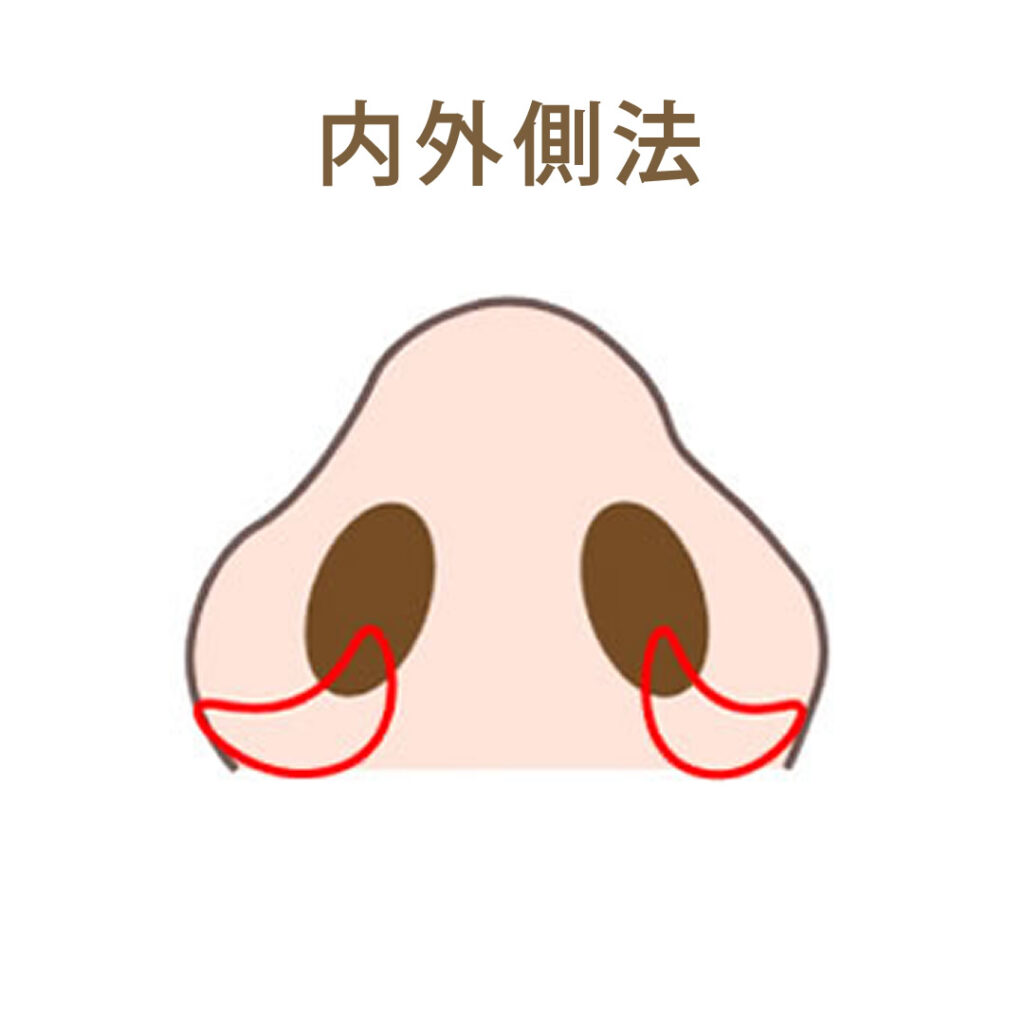 小鼻縮小内外側法の図解
