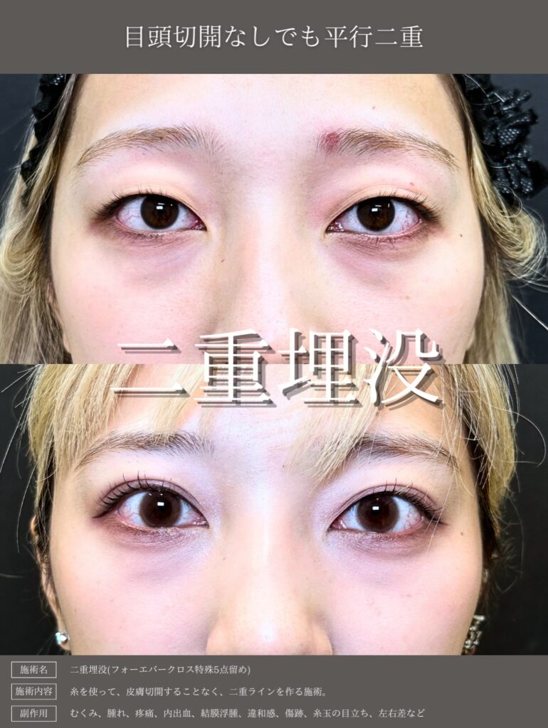 埋没法の症例写真 (20)
