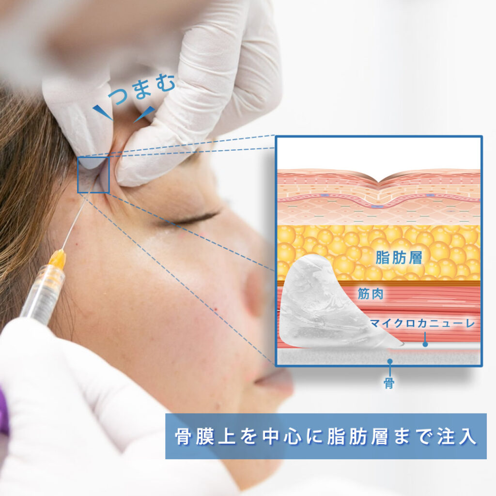 血管を持ち上げながらこめかみにヒアルロン酸を注入している様子