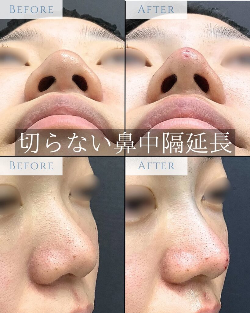 糸を使用した切らない鼻中隔延長の直後の症例